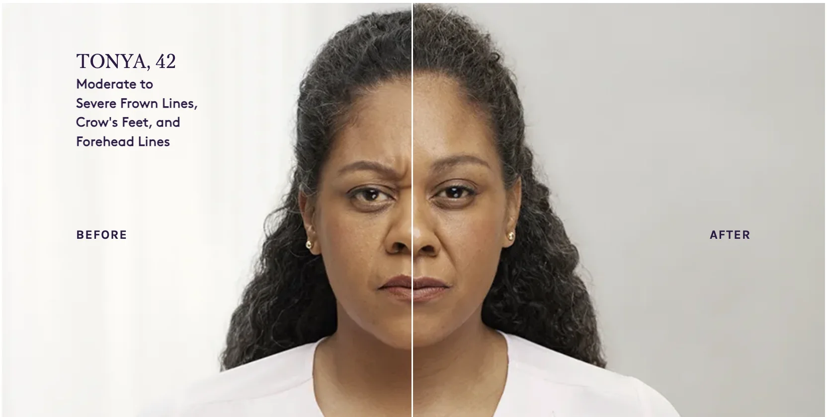 Example of Real Patient Botox Usage Case Link in the Description